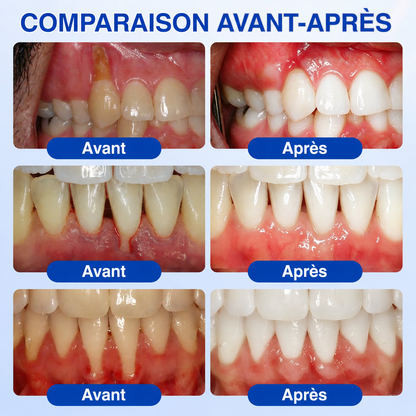 🇫🇷 𝑮𝒍𝒊𝒎𝒎𝒆𝒓𝒍𝒚®🦷 𝑮𝒖𝒎𝑹𝒆𝒗𝒊𝒗𝒆 𝑮𝒆𝒍 𝒅𝒆 𝑹é𝒑𝒂𝒓𝒂𝒕𝒊𝒐𝒏 𝑷𝒂𝒓𝒐𝒅𝒐𝒏𝒕𝒂𝒍𝒆💎