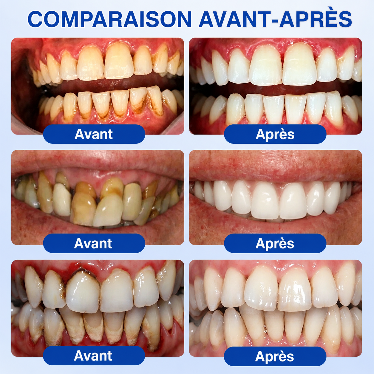 🇫🇷 𝑮𝒍𝒊𝒎𝒎𝒆𝒓𝒍𝒚®🦷 𝑮𝒖𝒎𝑹𝒆𝒗𝒊𝒗𝒆 𝑮𝒆𝒍 𝒅𝒆 𝑹é𝒑𝒂𝒓𝒂𝒕𝒊𝒐𝒏 𝑷𝒂𝒓𝒐𝒅𝒐𝒏𝒕𝒂𝒍𝒆💎