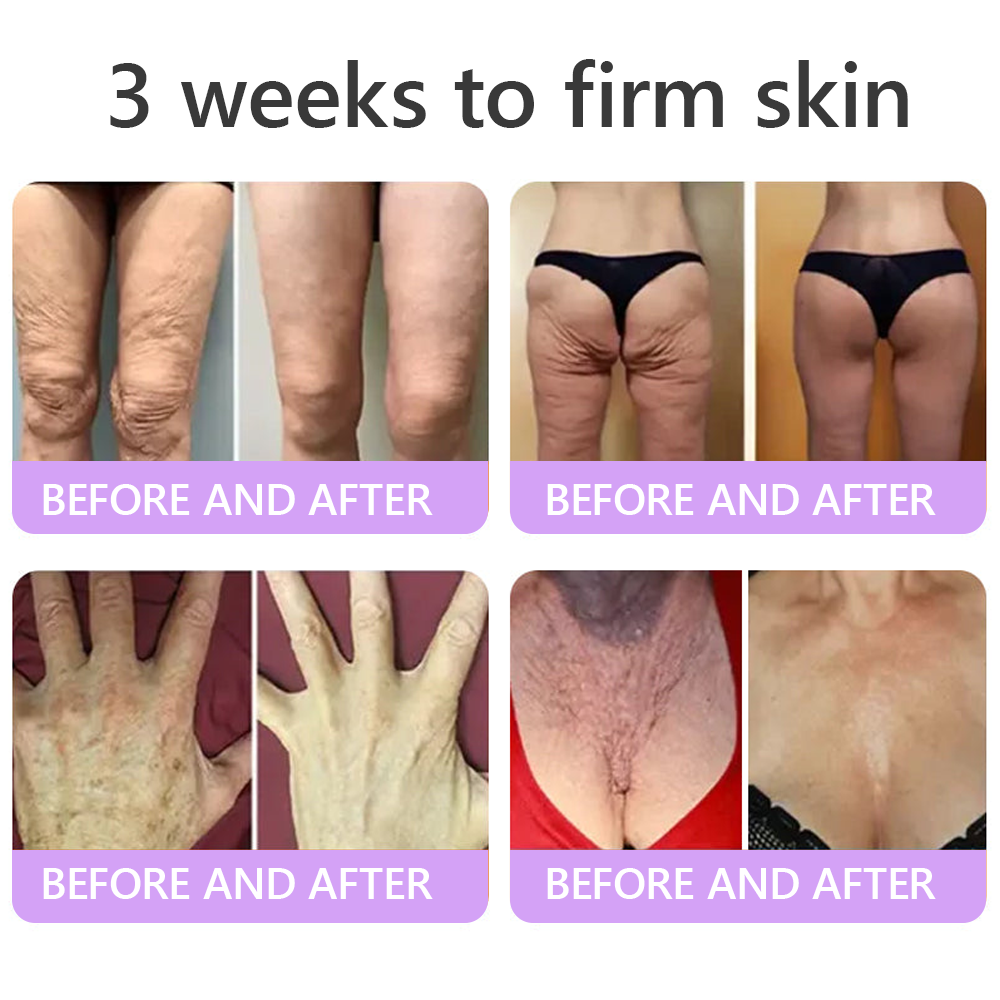 Vitalisys®🎉 PDRN Multi-Peptide Massaging Body Roller Cream- Anti-aging, Hydrating, Skin Firming & Lifting, Skin Repair, Even Tone, Acne and Dark Spot Treatment, Wart and Mole Removal, and Psoriasis Relief.