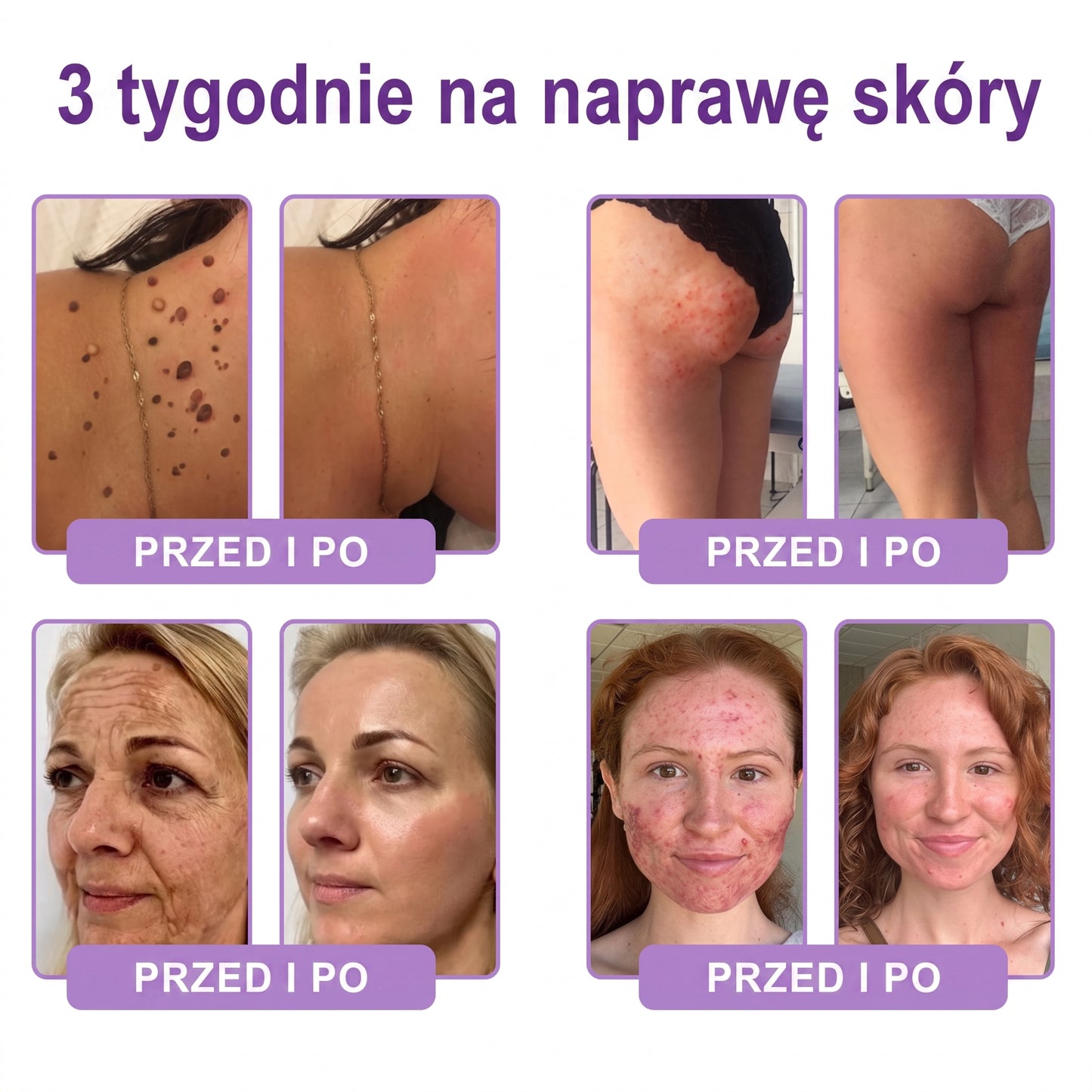 Vitalisys®🍇 PDRN Multi-Peptide Krem do masażu w rolerze do ciała — przeciwstarzeniowy, nawilżający, ujędrniający i liftingujący, wspiera regenerację skóry, wyrównuje koloryt, pomaga w pielęgnacji niedoskonałości i ciemnych plam.