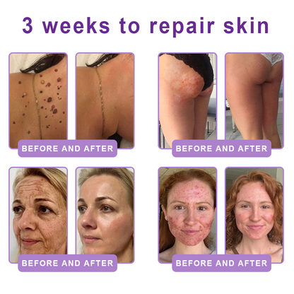 Vitalisys®🎉 PDRN Multi-Peptide Massaging Body Roller Cream- Anti-aging, Hydrating, Skin Firming & Lifting, Skin Repair, Even Tone, Acne and Dark Spot Treatment, Wart and Mole Removal, and Psoriasis Relief.