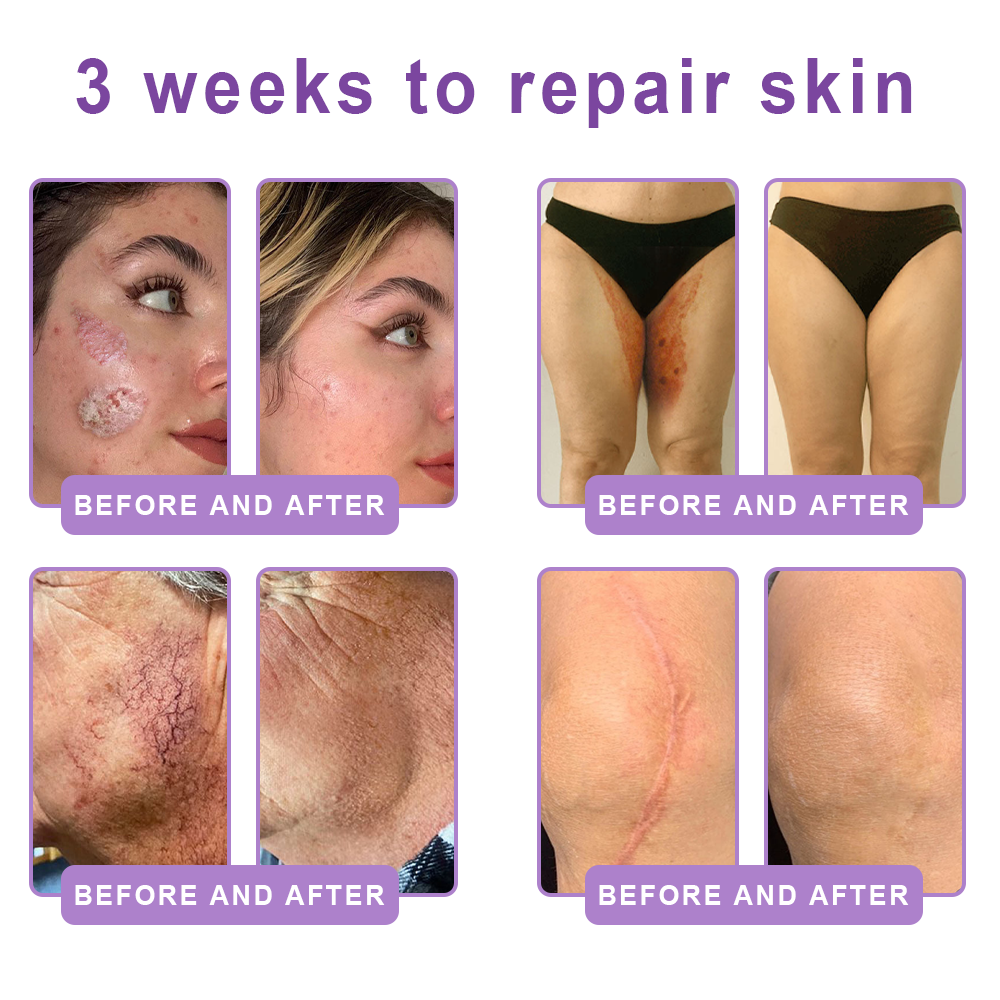 Vitalisys®🎉 PDRN Multi-Peptide Massaging Body Roller Cream- Anti-aging, Hydrating, Skin Firming & Lifting, Skin Repair, Even Tone, Acne and Dark Spot Treatment, Wart and Mole Removal, and Psoriasis Relief.