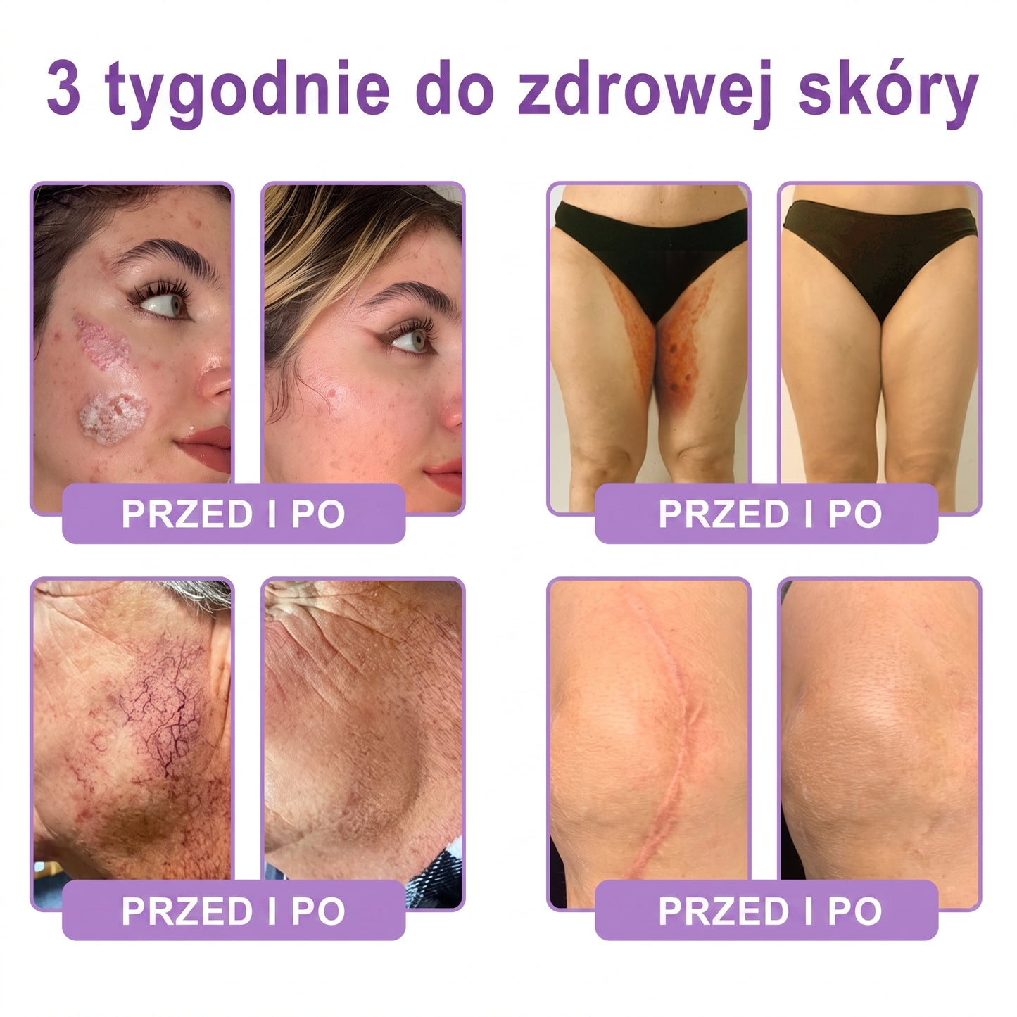 Vitalisys®🍇 PDRN Multi-Peptide Krem do masażu w rolerze do ciała — przeciwstarzeniowy, nawilżający, ujędrniający i liftingujący, wspiera regenerację skóry, wyrównuje koloryt, pomaga w pielęgnacji niedoskonałości i ciemnych plam.